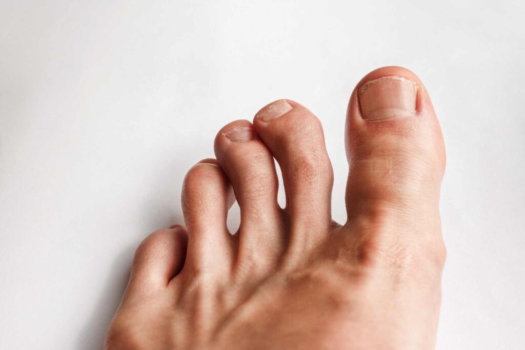 Toe Deformities and Proper Footwear // Texas Foot and Ankle Center