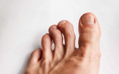 Toe Deformities and Proper Footwear