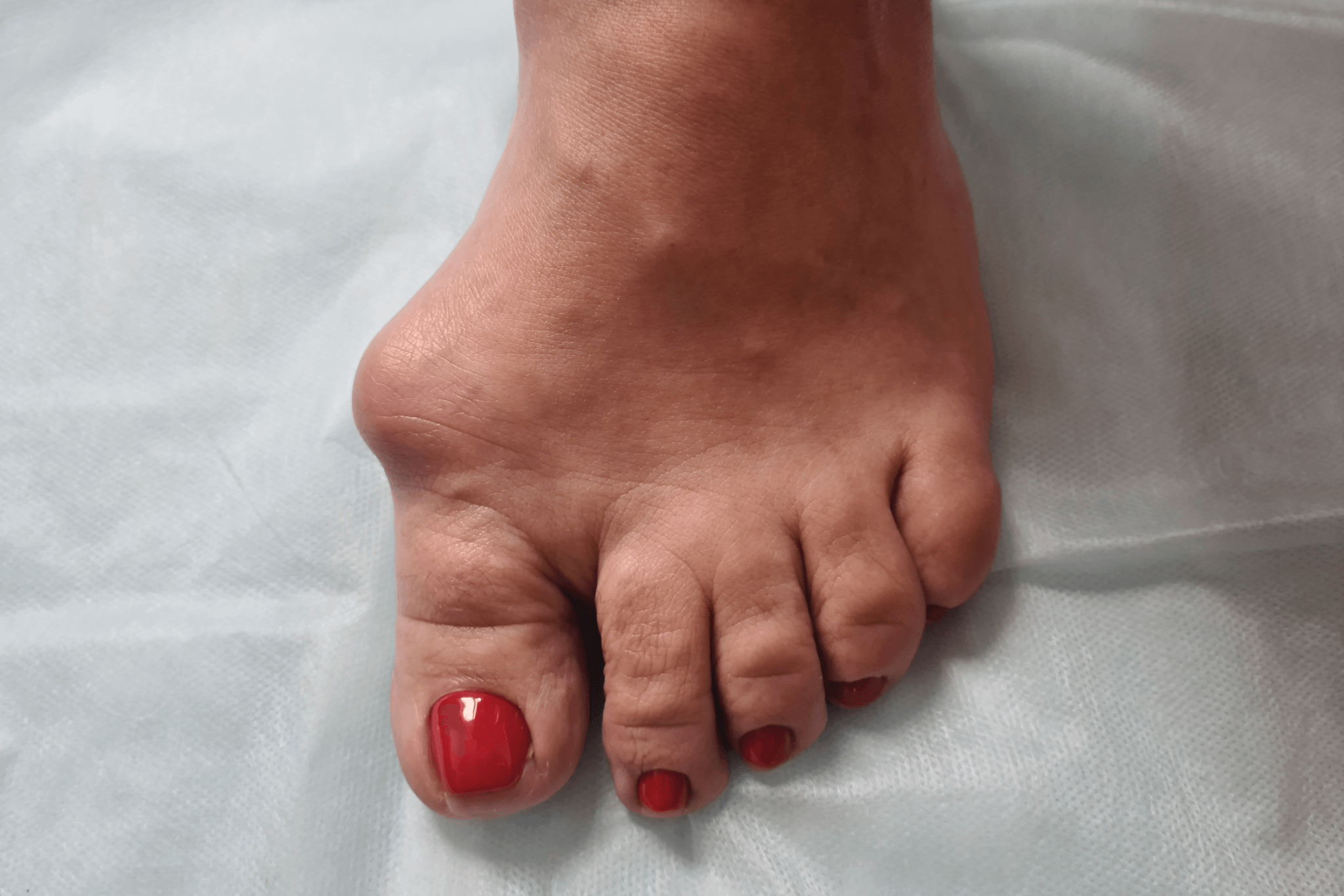 Woman suffers from inflammation of big toe bone