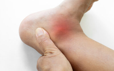 What is an Ankle Sprain?