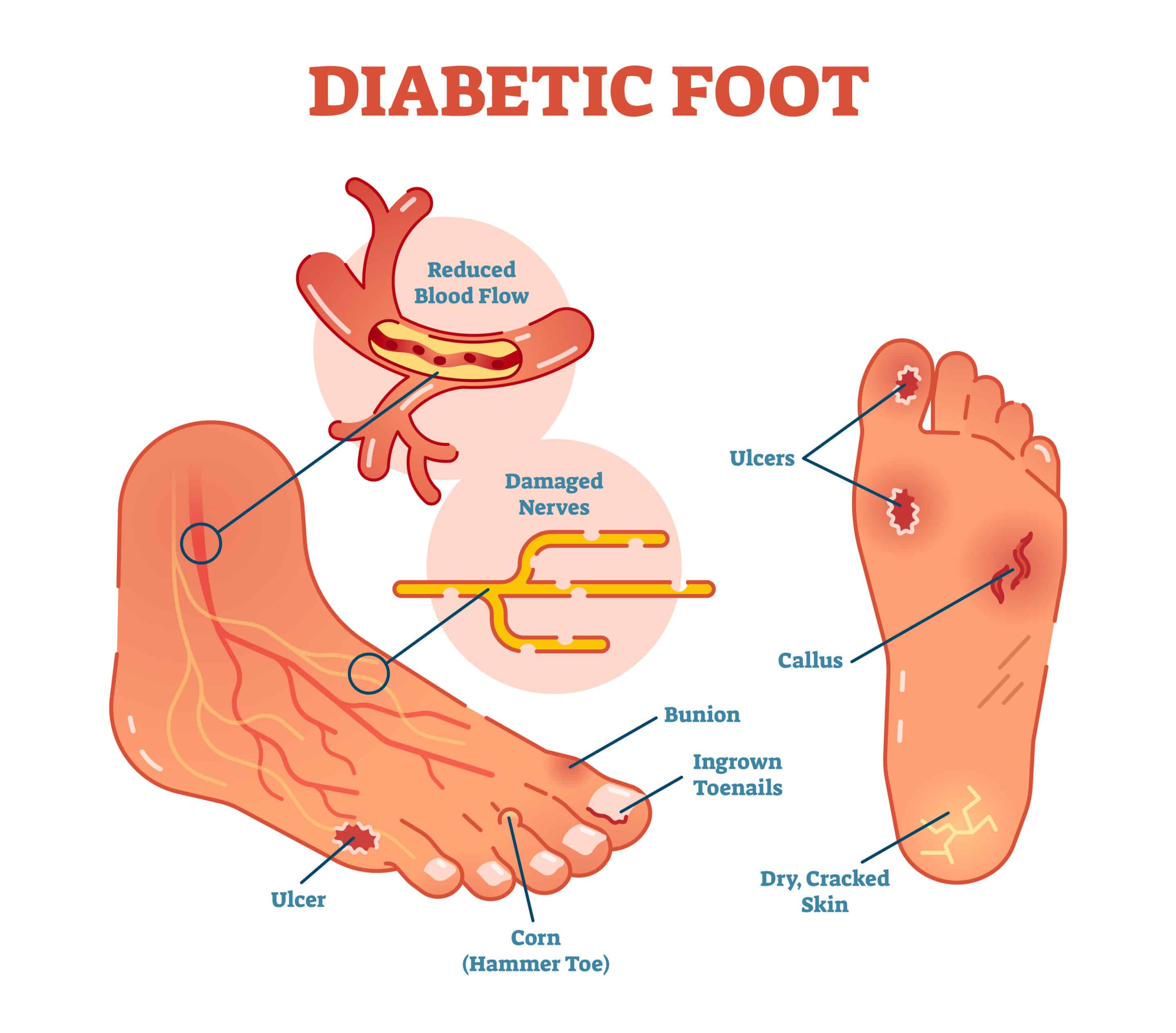 diagram of diabetic foot wounds 