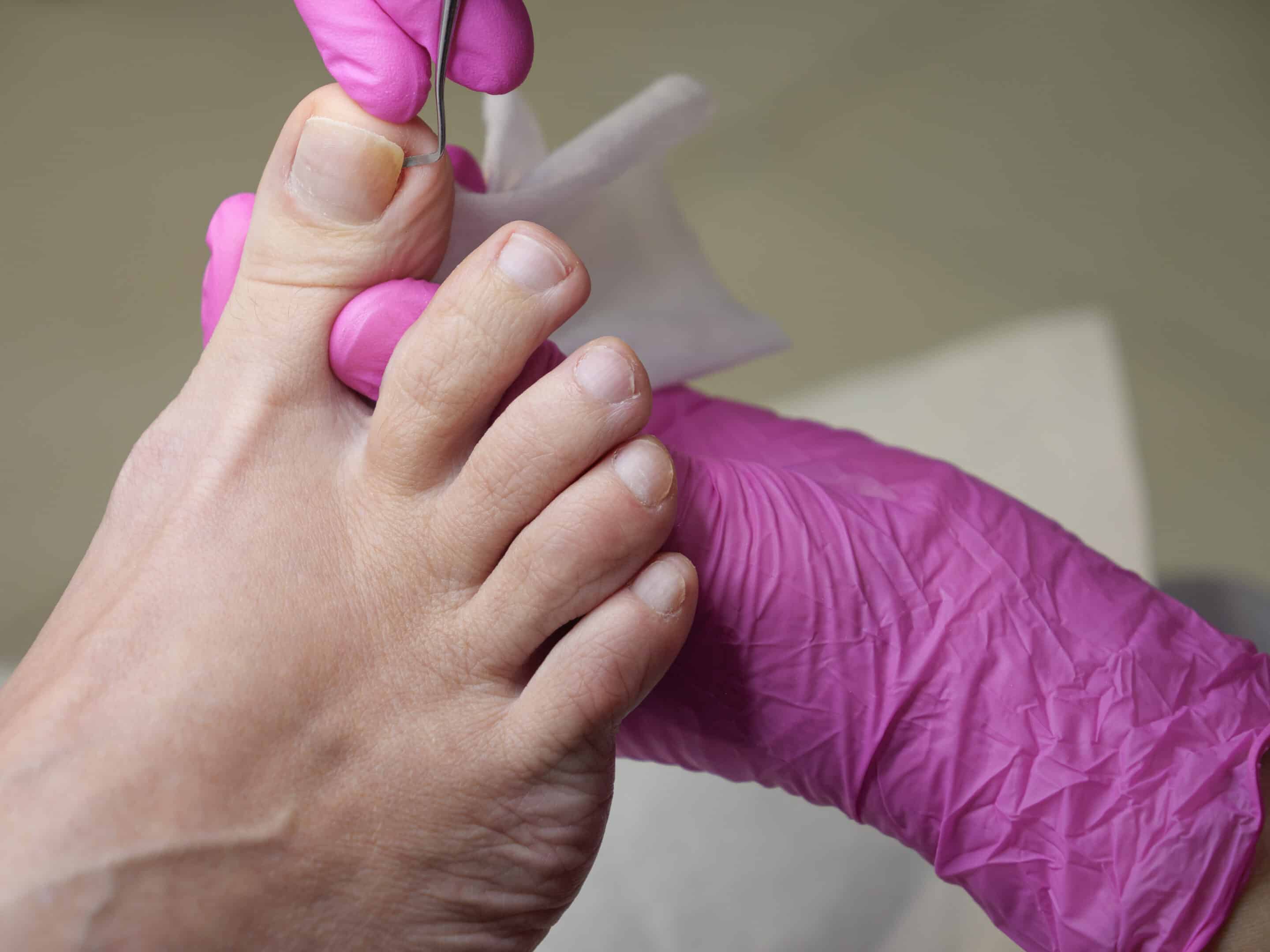 Close-up of a female right foot that undergoes a treatment of an ingrown toenail on a big toe Close-up of a female right foot that undergoes a treatment of an ingrown toenail on a big toe
