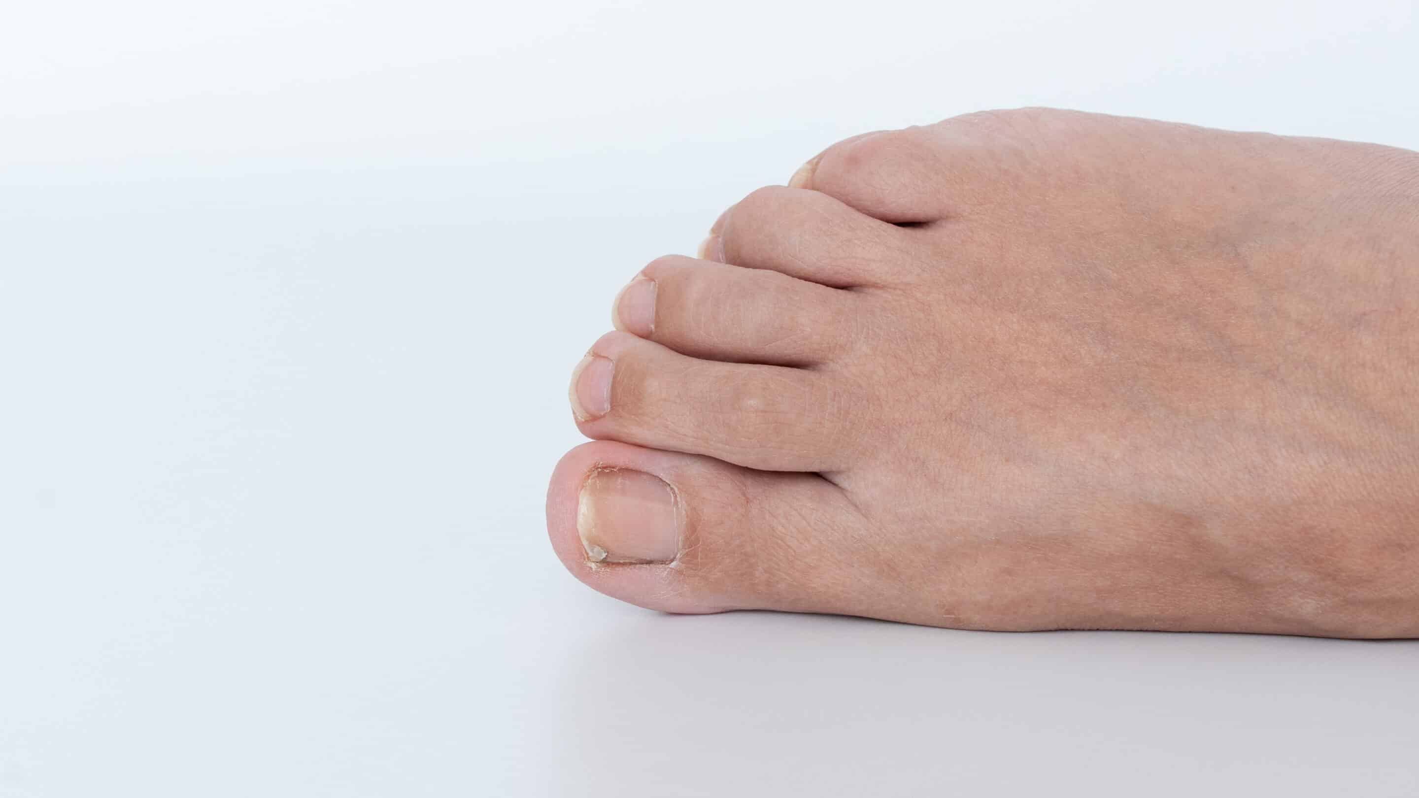 Close-up of a human foot with an ingrown toenail, showcasing the affected area and surrounding skin texture, illustrating foot health concerns Close-up of a human foot with an ingrown toenail, showcasing the affected area and surrounding skin texture, illustrating foot health concerns